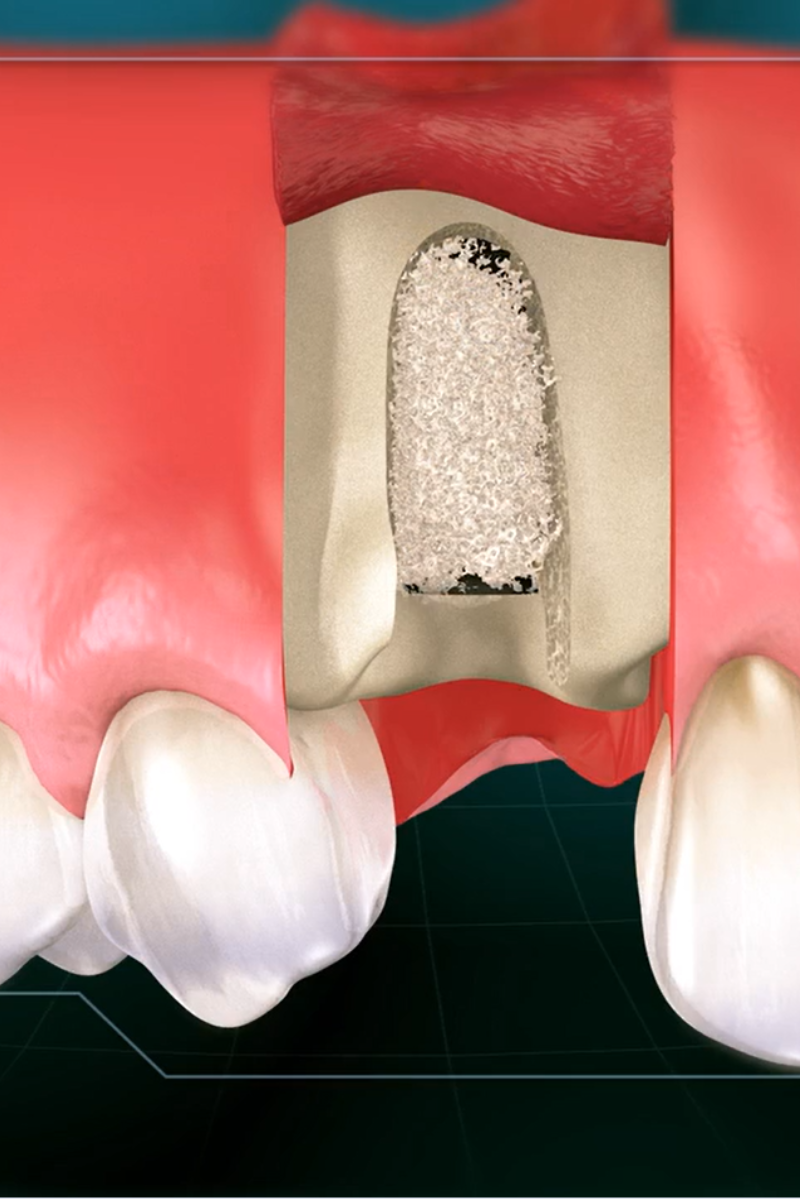 Socket Preservation: Essential Step to Lasting Dental Implant Success